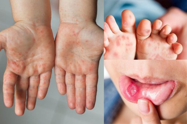 Tăng cường theo dõi người bệnh tay chân miệng, hạn chế thấp nhất ca tử vong